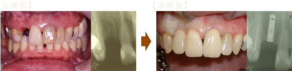 前歯部破損のケース