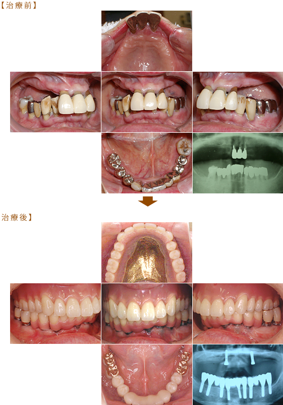 インプラントのアタッチメントを使用した入歯
